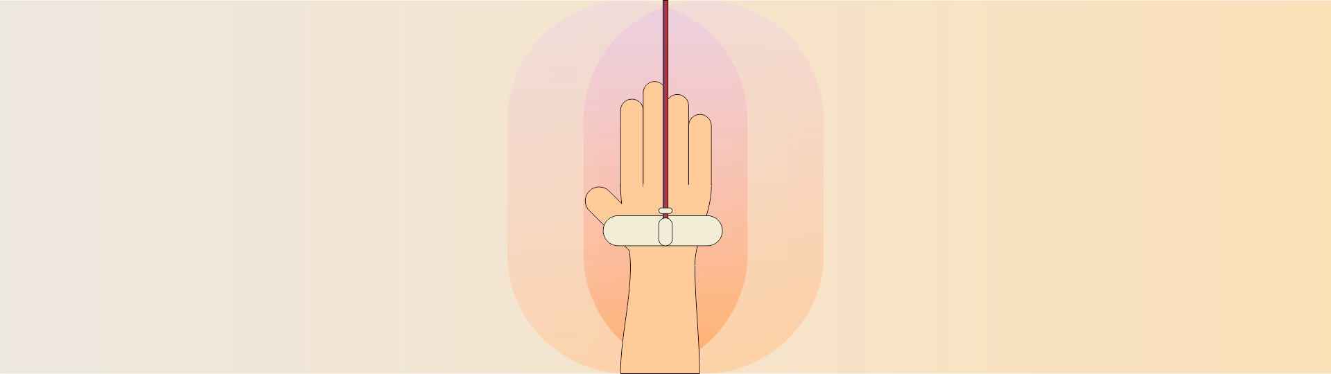 Ilustração de um acesso vascular no pulso de uma mão.