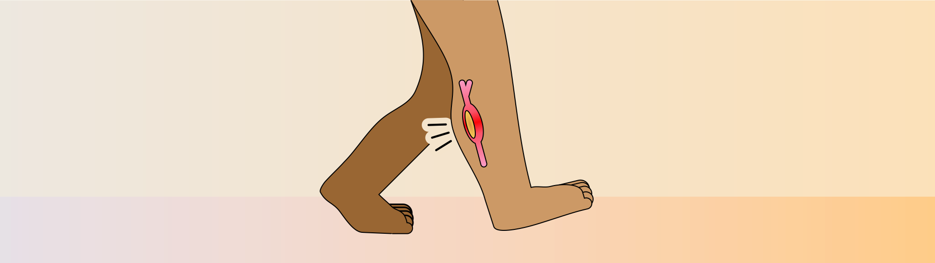 Ilustração de uma pessoa com dores na panturrilha.