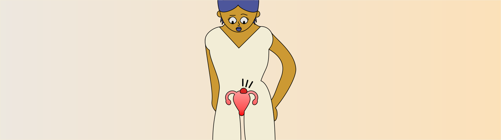 Ilustração de uma pessoa com um mioma no útero.