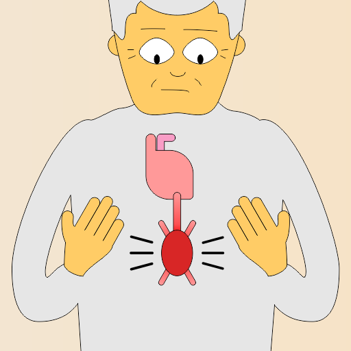Ilustração de uma pessoa com um aneurisma na artéria aorta.
