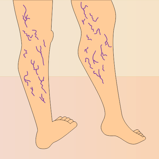 Ilustração de uma perna com varizes.